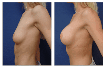 Breast enhancement New Port