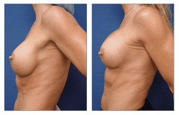 breast augmentation surgery patient 11 left view