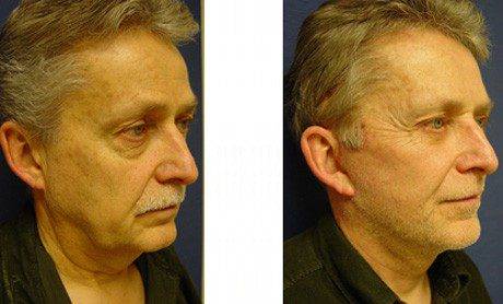 facelift patient 4 front right - Facelift Side Effects