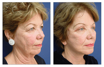 Neck Lift Beverly Hills