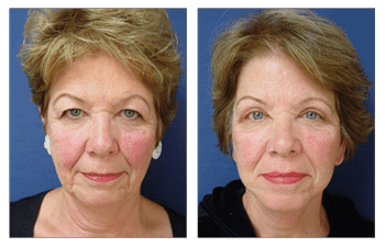 Neck Lift Newport Beach