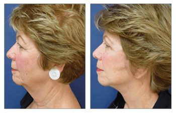 Facelift Surgery Video