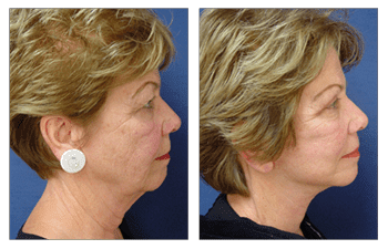 Facelift Surgery Los Angeles