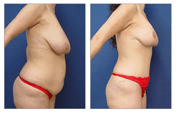 Mommy Makeover Newport Beach, Tummy Tuck