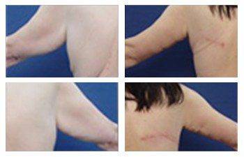 arm band deformity surgery before and after