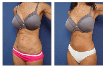 tummy tuck patient 48 right view