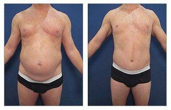 Tummy Tuck and Liposuction on Male Weight Loss Patient