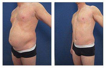Fat grafting procedure