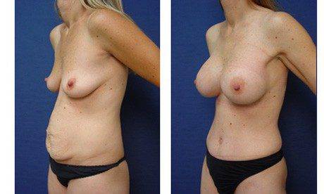 tummy tuck patient 26 front left