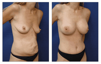 tummy tuck patient 26 front right view