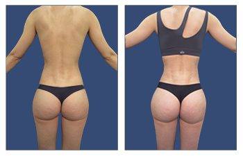 Brazilian Buttock lift cost, SurgiSculpt