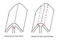 open-rhinoplasty-patient