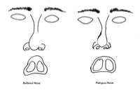 rhinoplasty