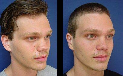 Secondary rhinoplasty