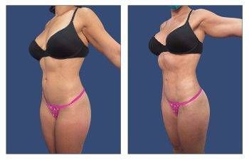 Before and after pictures showcasing the incredible transformation achieved through a mini tummy tuck procedure.