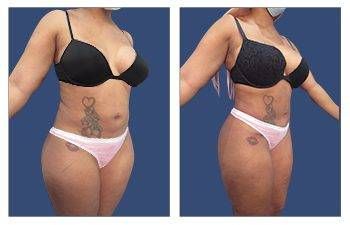 Skinny Little BBL Before & After Photos, Westfield, NJ