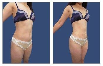 Mini Tuck And Tummy Tuck (abdominoplasty) Before & After Photos Patient 06