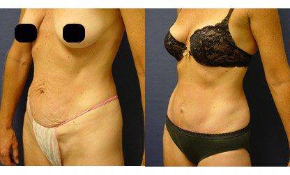 mini tummy tuck patient 7 front left