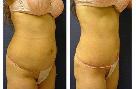 mini tummy tuck patient 8 front right