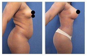 high definition liposuction right view