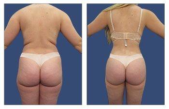 Mini Natural Butt Lift® Beverly Hills, Los Angeles, Mini Butt Lift