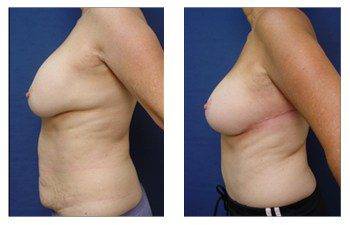 breast augmentation revision patient 1 left view