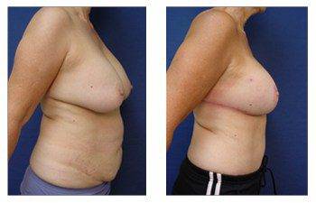 Breast Augmentation Revision Cost SurgiSculpt