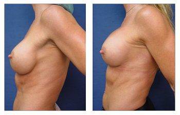 Breast Augmentation Revision Surgery