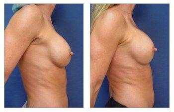 Breast implant in Newport Beach