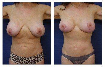 breast augmentation revision recovery patient 9 front view - Breast Augmentation Revision Of Aged