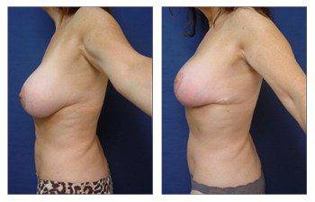 breast augmentation revision recovery patient 9 left view - Breast Augmentation Revision Of Aged