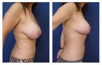 breast augmentation revision recovery patient 9 right view - Breast Augmentation Revision Of Aged