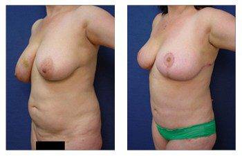 cheapest breast lift patient 10 front front left view