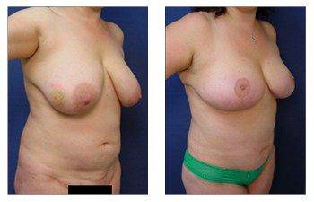 cheapest breast lift patient 10 front right view