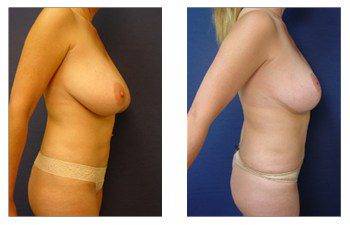 breast lift risks patient 12 right view