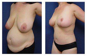 breast lift procedure patient 17 front left view