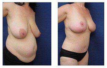 breast lift procedure patient 17 front right view