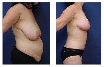 breast lift procedure right view