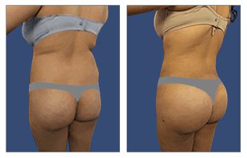 How Common is Buttock Implants