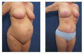 breast lift patient 1 front right view