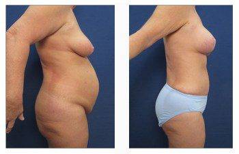 breast lift patient 1 right view