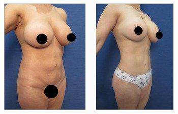 High Definition Liposuction Revision