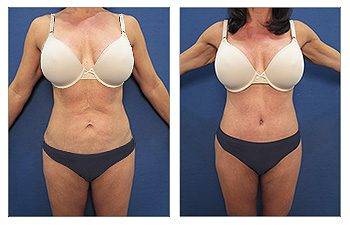 VASER Tummy Tuck