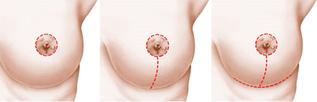 examples of the three major breast lift options