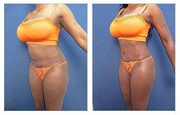 Liposuction of the flanks Beverly Hills - Smaller Waist- Flanks Lipo