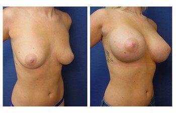 Breast Augmentation to Go Bigger, CPSI.