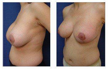 breast augmentation revision patient 16 front left view