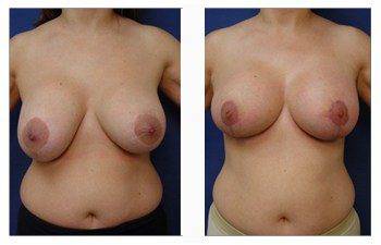 breast augmentation revision patient 16 front view