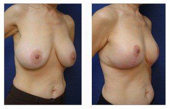 breast lift and augmentation patient 19 front right view