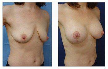 breast lift with implants patient 29 front right view